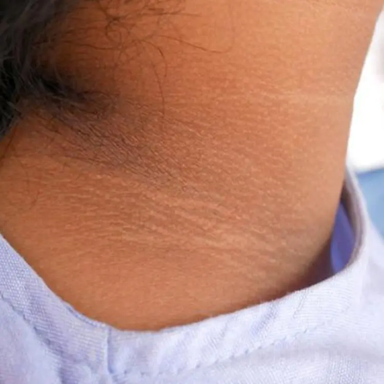 After Body Treatment Results