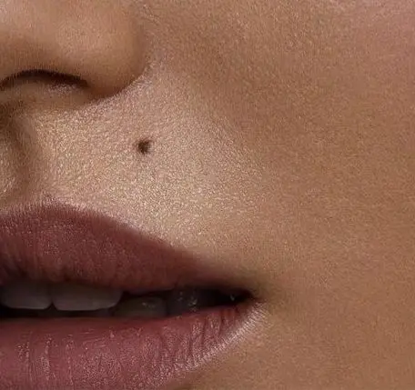 False Beauty Spot Procedure